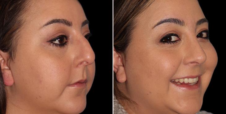 Open Rhinoplasty Results In Atlanta GA ¾ Right View